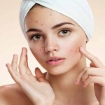 Acne-Triggers