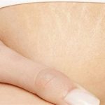 For Stretch Marks